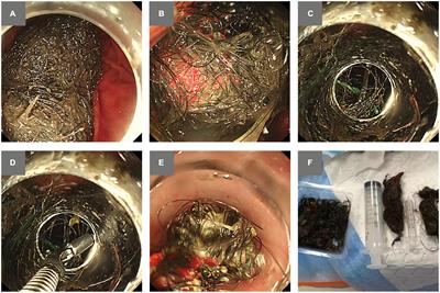 Endoscopic removal of a massive trichobezoar in a pediatric patient by using a variceal ligator cap: A case report and literature review